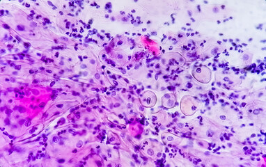 Paps smear. Microscopic examination of pap smear showing inflammatory smear with early atrophic...