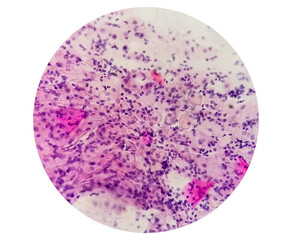 Paps smear. Microscopic examination of pap smear showing inflammatory smear with early atrophic changes. NILM. cervical cancer diagnosis.