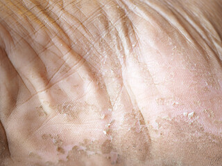 dry skin or ichthyosis texture detail in women using for moisturizer lotion, cream or beauty...