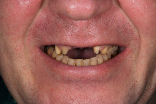 Smile with teeth prepared for ceramic crowns and veneers