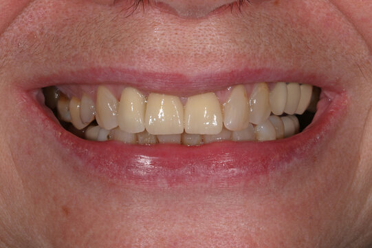 Smile with ceramic crowns and veneers