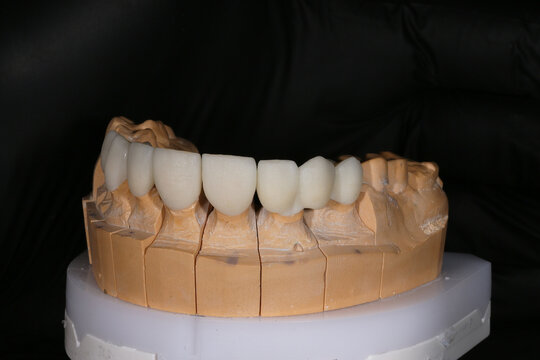 Ceramic crowns and veneers on a gypsum model. Zirconia crowns. Metal-free ceramics at the manufacturing stage. Close-up