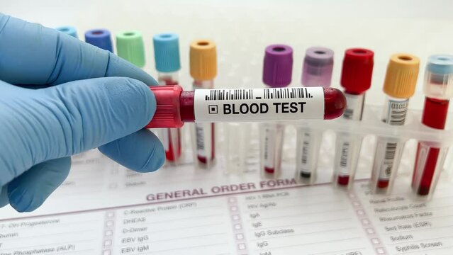 Doctor holding Blood test tube for analysis of blood chemist study in the laboratory. Lab technician assistant or doctor holding a blood testing over requisition report for analysis chemistry