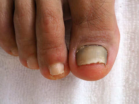 Closeup of foot with a fungus on nails or onycholysis