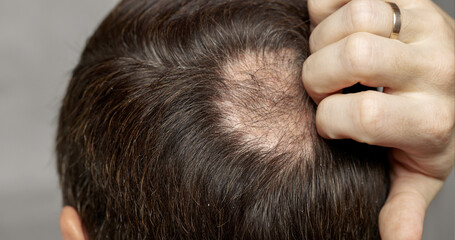 Man with hair loss problems closeup, isolated. Alopecia balding hairs on man scalp. Human alopecia or hair loss - person hand pointing his bald head. Scratching his head. Baldness. Depression, stress - 547706196