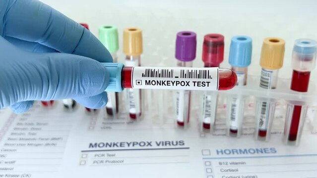Doctor holding Blood sample tube for analysis of monkeypox test in the laboratory. Lab technician assistant or doctor holding Blood testing over requisition report for Monkeypox virus test