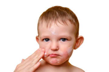 Mother smears allergy cream on face of toddler baby, studio white background. Close-up portrait of a cute baby with cream on her cheeks. Kid aged one year and two months