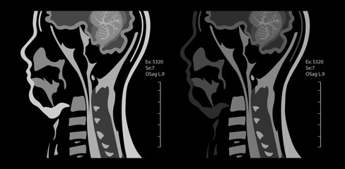 Magnetic resonance imaging of the cervical spine spine. Spondylosis and spinal cord compression