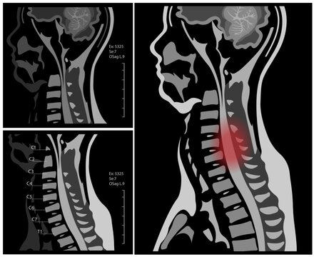  MRI of the cervical spine with and without contrast, MRI with bilateral C7 root compression, Cervical spondylosis