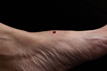 Naklejka premium Close-up view of bleeding on the foot from leech biten.