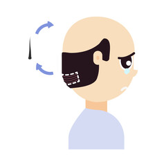 FUE hair transplant treatment of alopecia. Side view of a man. Male hair loss pattern. Medical infographics. Cartoon vector illustration.