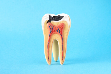 Close-up internal tooth structure model with fisrt step of caries decay  on blue background