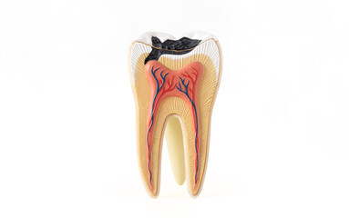 Isolated photo of internal tooth structure model with caries destruction on white background