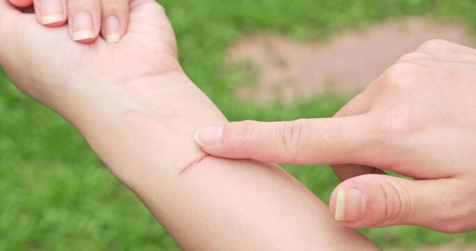 Close Up blisters, Scar reducing treatment, scar removal cream, skin care product. Scar of a woman caused by an accident. problem skin on hand.