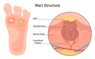 Foot warts. Type of human papillomavirus on the bottom of soles and toes