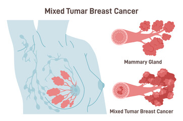 Mixed breast carcinoma. Detailed breast medical anatomy with lactiferous
