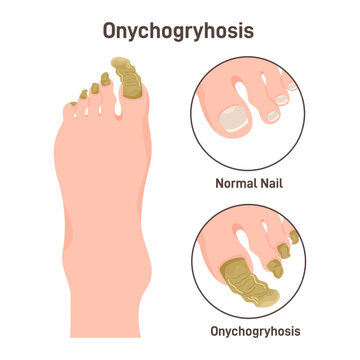Onychogryphosis or ram's horn nails. Nail disease, when toenails