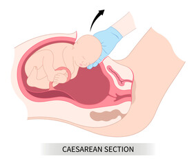 Newborn Baby birth prolapse umbilical cord twins Pregnancy scar womb tummy women Spinal Anaesthesia block uterus infant Fetal fetus mother belly Labour feet high blood pressure preeclampsia pain - obrazy, fototapety, plakaty