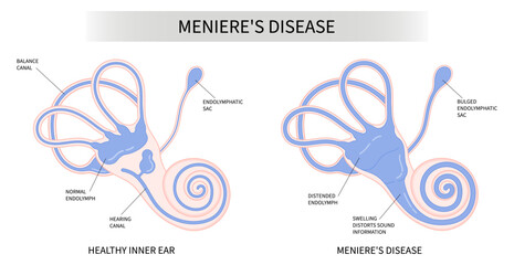 The Meniere's disease of sound in stuffy ear hear ringing roaring buzzing loss of balance dizzy spells pressure headache - obrazy, fototapety, plakaty