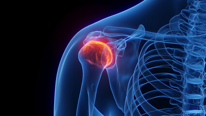 3D rendered Medical Illustration of Male Anatomy - Inflamed Shoulder Joint. - 547988951