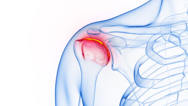 3D rendered Medical Illustration of Male Anatomy - Inflamed Shoulder Joint.