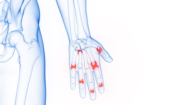 3D Rendered Medical Illustration of Inflamed Hand