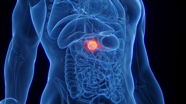 3D Rendered Medical Illustration of Male Anatomy - Pancreatic Cancer.