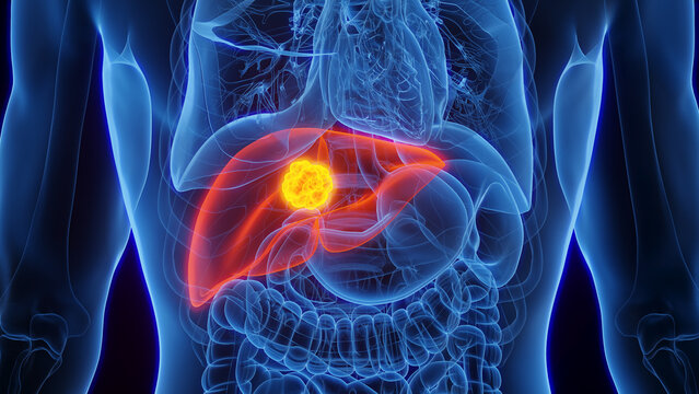 3D Rendered Medical Illustration of Male Anatomy - Liver Cancer.