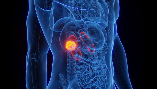 3D Rendered Medical Illustration of Male Anatomy - Kidney Cancer.