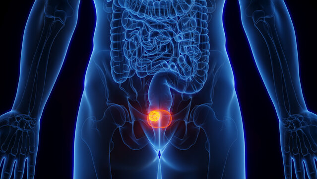 3D Rendered Medical Illustration of Male Anatomy - Bladder Cancer.