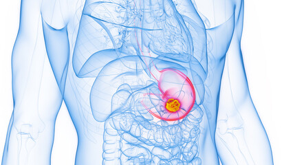 3D rendered Medical Illustration of Male Anatomy - Stomach Cancer.