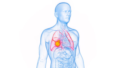 3D rendered Medical Illustration of Male Anatomy - Lung Cancer.