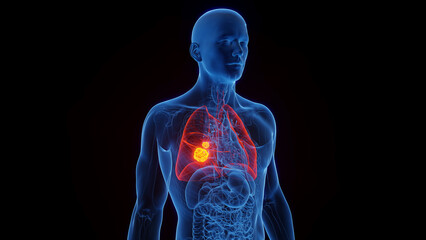 Plakat 3D Rendered Medical Illustration of Male Anatomy - Lung Cancer.