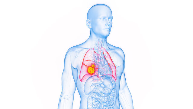 3D rendered Medical Illustration of Male Anatomy - Lung Cancer.