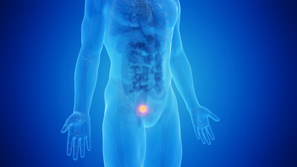 3D Rendered Medical Illustration of Urinary Bladder Cancer. - obrazy, fototapety, plakaty