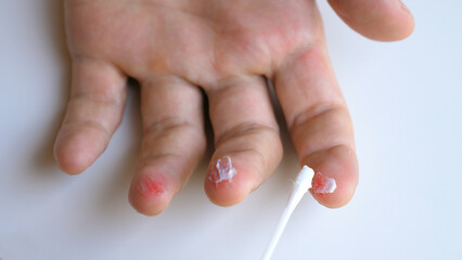 Doctor treats adult patient. Male arm apply medicinal ointment by cotton swab on injured sore...