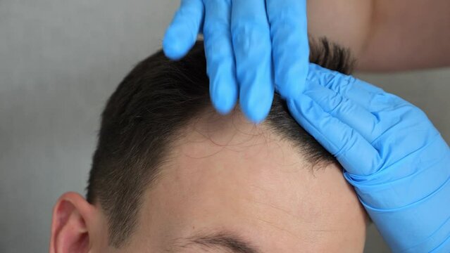 Hands of doctor in rubber gloves doing checkup of hair of man to fight male-pattern baldness. Patient gets prepared for hair transplant surgery closeup