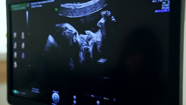 Ultrasonic picture of a baby in mom’s womb at the black screen. Checking the child’s development with the help of modern equipment. Close up.