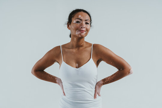 Beautiful Woman With Vitiligo Skin Posing In Studio. Concept About Body Positivity And Self Acceptance