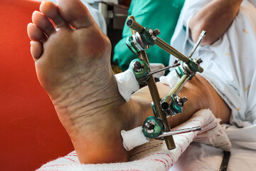 Bone fracture foot and leg on femenine patient with splint clamping mechanism post surgery and...