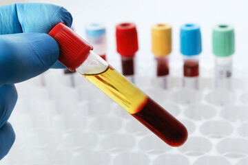 Blood drawn from a patient with Serum separate in the chemistry laboratory. Lab technician holding a test tube of blood sample after being centrifuged