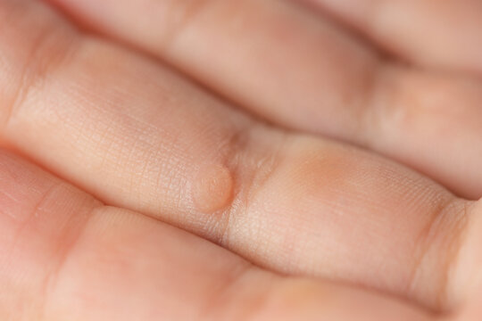 Wart on the finger. Close-up of a wart on a child's finger. The common wart Verruca vulgaris is caused by a type of human papillomavirus, HPV.