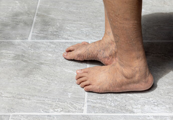 Elderly woman feet have varicose veins
