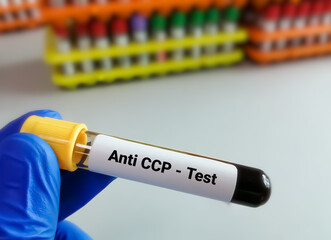 Blood sample for Anti CCP test, diagnosis of rheumatoid arthritis disease. Cyclic Citrullinated...