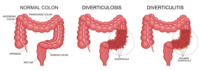 Diverticulitis and diverticulosis vector illustration. Medical structure and location. Diverticula infected or inflamed. Intestines. Bowel colon cancer, crohn's disease polyp hernia rectum - obrazy, fototapety, plakaty