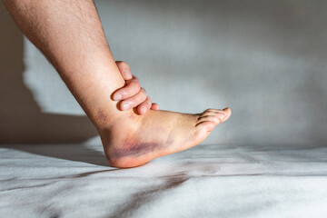 Sprained and swollen ankle.Man hold his sprained ankle.Ankle sprain.Injury.White,gray...