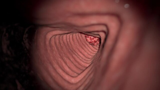 3D Rendered Animation of a cancerous tumor in the large intestine.