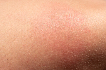 Naklejka premium Allergy on the human body and redness from a wasp sting.