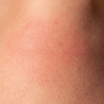 Allergy on the human body and redness from a wasp sting.
