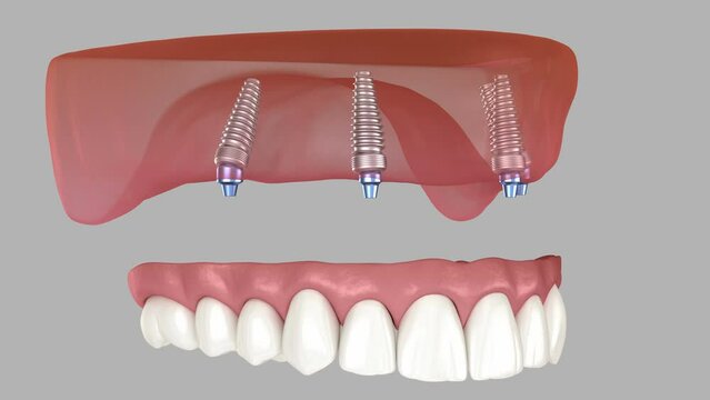Removable prosthesis supported by four implants. Dental 3D animation